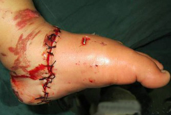 電瓶車絞斷女童左腳 醫生呼吁強制安裝防護網